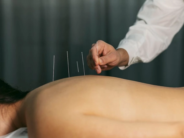 Acupuntura Sistêmica Acupuntura Sistêmica